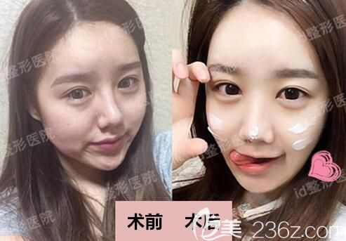 韩国id整形崔在镐耳软骨复合隆鼻案例 韩国id整形崔在镐耳软骨复合隆鼻案例