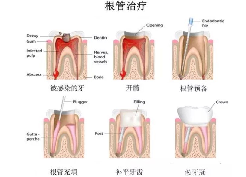 根管治疗的步骤图解 根管治疗的步骤图解