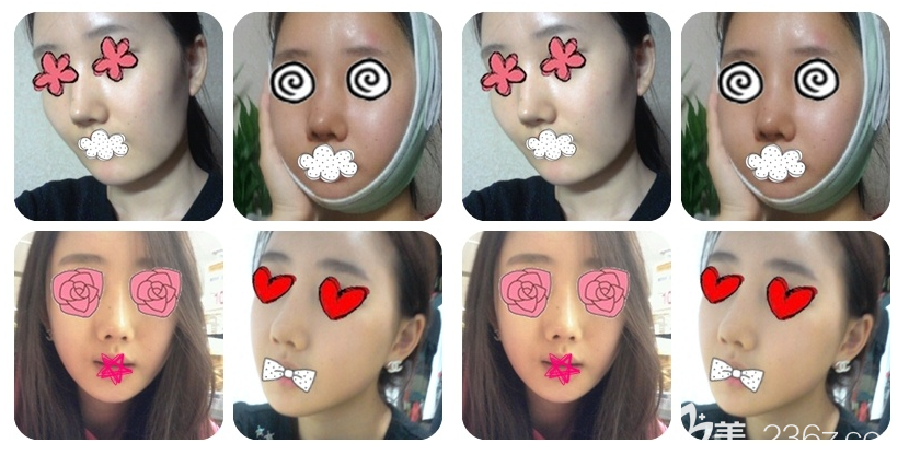 韩国博朗温接受人字截骨和3D颧骨术案例图