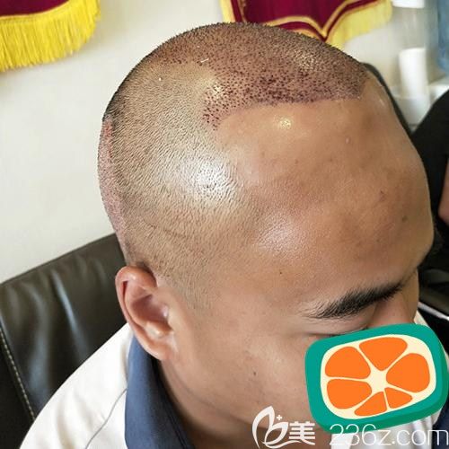 成都碧莲盛植发术后即刻效果图