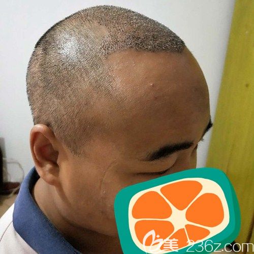 成都碧莲盛头顶加密种植术后5天