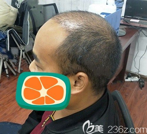 在成都碧莲盛用SHT无痕种植技术植发际线加头顶加密2500单位后改善了我的地中海发型