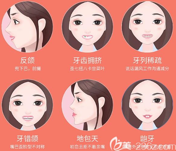 哪些牙齿情况可以戴隐适美牙套 哪些牙齿情况可以戴隐适美牙套