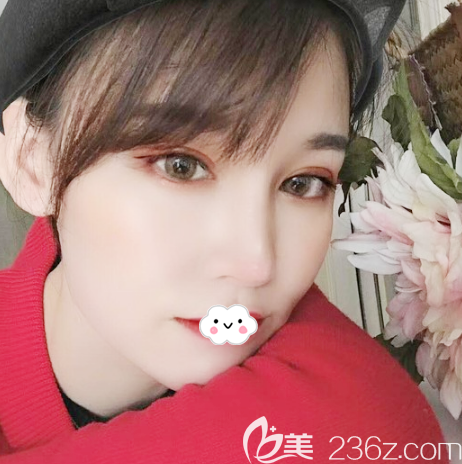 广州艺美整形眼鼻脂肪填充一个月案例效果图