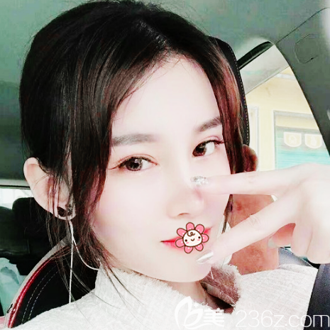 广州艺美整形张涛双眼皮隆鼻脂肪填充案例效果图