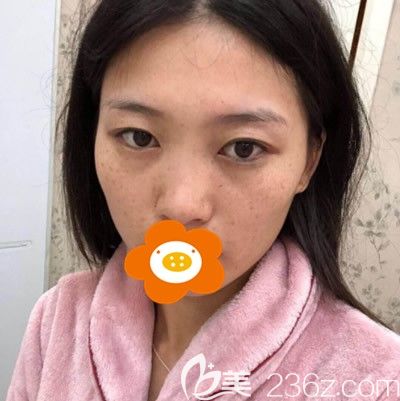 在泉州欧菲做隆鼻手术前的我 在泉州欧菲做隆鼻手术前的我