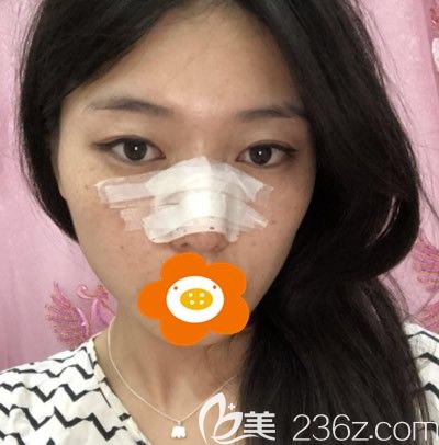 <!--<i data=20240703-sp></i>-->先主任为我做肋软骨隆鼻手术后第3天 <!--<i data=20240703-sp></i>-->先主任为我做肋软骨隆鼻手术后第3天