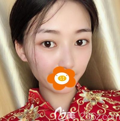 术后半个月鼻子还有点肿 术后半个月鼻子还有点肿