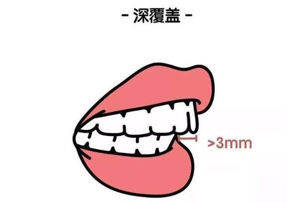 西诺口腔张瑶主任解析：27岁深覆盖矫正要多久