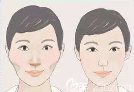 颧骨颧弓手术前后