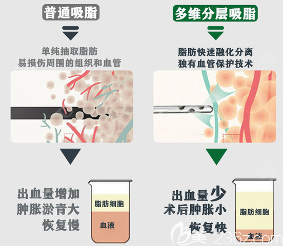 广州艺美整形李向阳医生吸脂优势