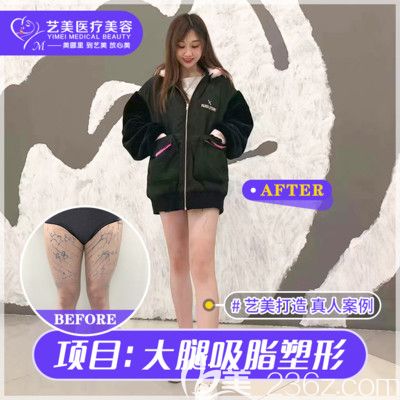 广州艺美整形李向阳大腿吸脂案例 广州艺美整形李向阳大腿吸脂案例