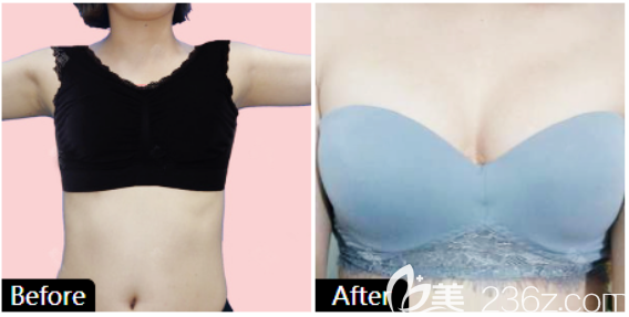 广州艺美整形李向阳医生隆胸案例 广州艺美整形李向阳医生隆胸案例