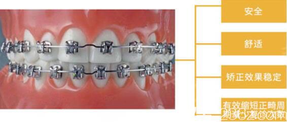 武汉壹加壹金属自锁托槽矫正优势