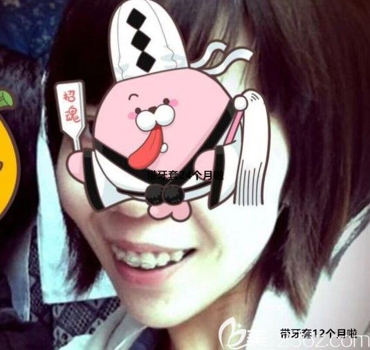 带陶瓷半隐形牙套12个月 带陶瓷半隐形牙套12个月