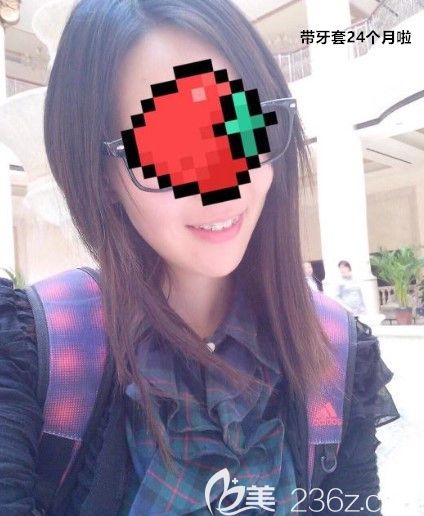 在西诺口腔矫正龅牙1年的效果图 在西诺口腔矫正龅牙1年的效果图