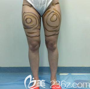 我在北京艺美做腿部吸脂前样子 我在北京艺美做腿部吸脂前样子