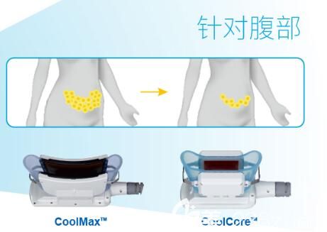酷塑冷冻溶脂仪器上针对腰腹有专业的探头