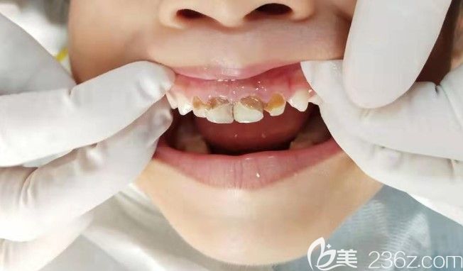 儿童龋齿需要治疗吗