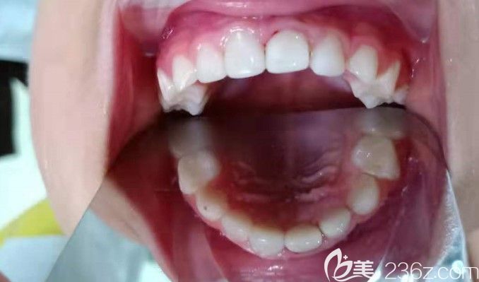 儿童蛀牙值得重视!广州5岁龋齿小宝贝不久前才在阳光树口腔戴了牙冠+根管治疗+补牙
