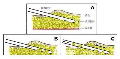 大腿吸脂的手术原理
