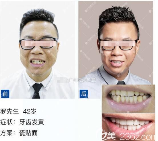 牙齿发黄牙齿贴面案例 广州曙光口腔