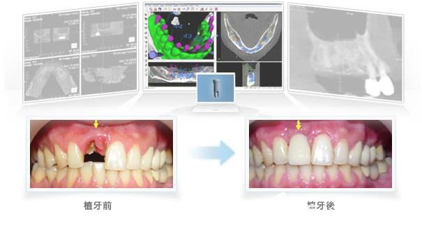 深圳徕可口腔种植牙 深圳徕可口腔种植牙