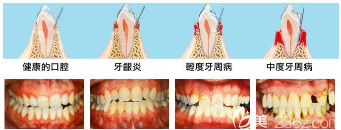 深圳徕可口腔牙周治疗