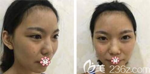 术前我成了内双 术前我成了内双