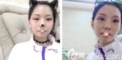 李曾显医生给我做完手术后5天 李曾显医生给我做完手术后5天