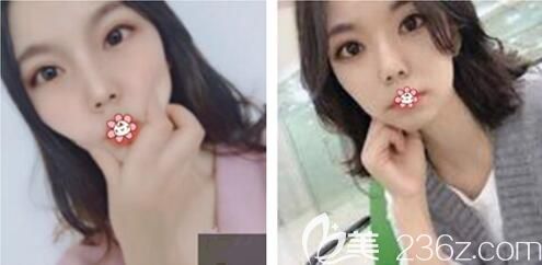 重庆好美整形双眼皮修复术后48天 重庆好美整形双眼皮修复术后48天