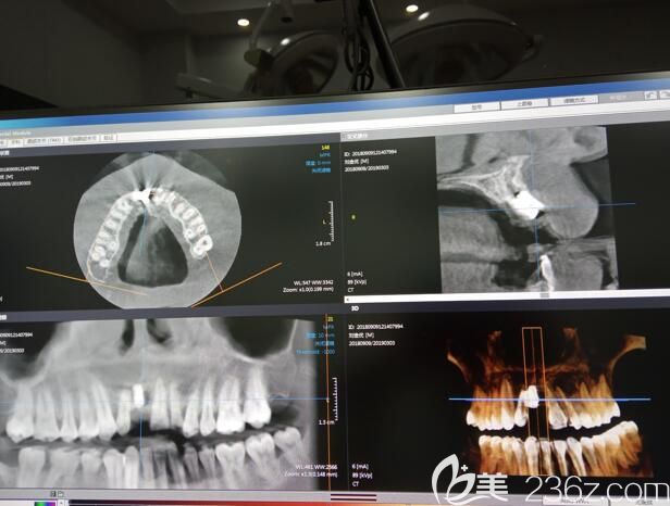 我在广州阳光树口腔做种植牙的CT片