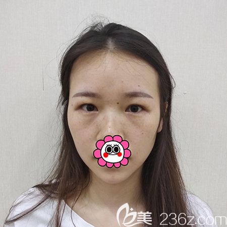 到杭州维多利亚做双眼皮前 到杭州维多利亚做双眼皮前