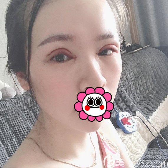 刚做完双眼皮的样子 刚做完双眼皮的样子