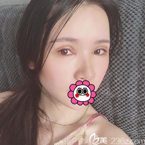 恢复5天的双眼皮消肿了不少 恢复5天的双眼皮消肿了不少