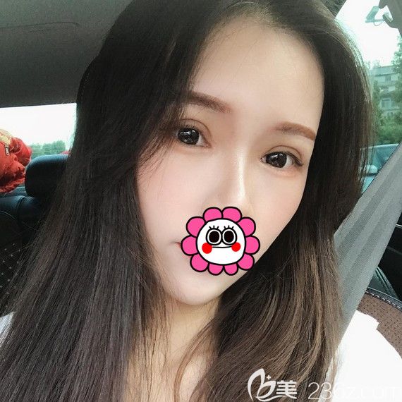 杭州维多利亚双眼皮恢复一个月效果 杭州维多利亚双眼皮恢复一个月效果