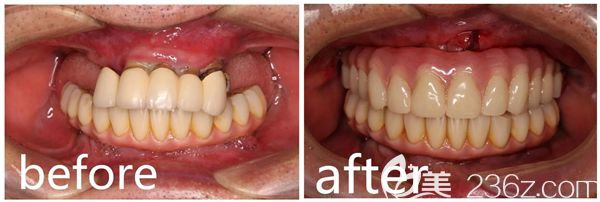 黎医生做穿颧种植手术前后对比图