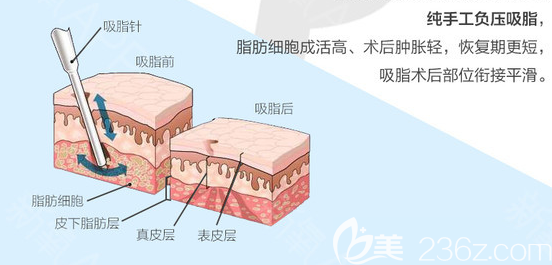 深圳南雅整形医院张燕发吸脂手术原理图