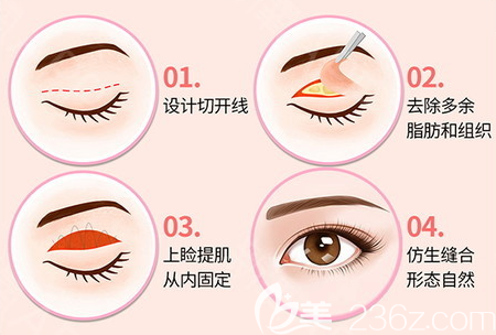 深圳南雅整形医院张燕发双眼皮手术分解图