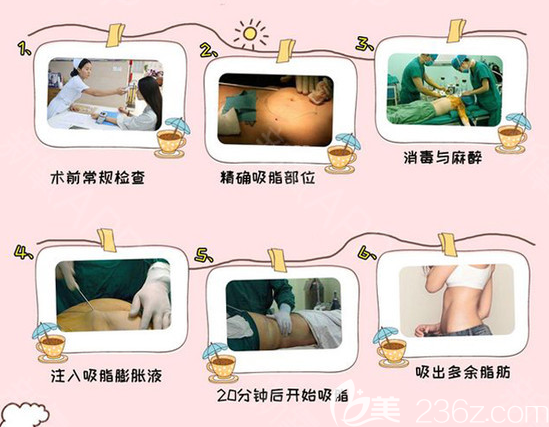 珠海九龙整形张成春吸脂手术过程图