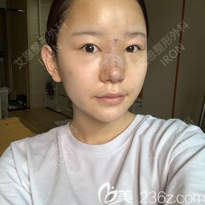 艾恩整形术后第3天 艾恩整形术后第3天