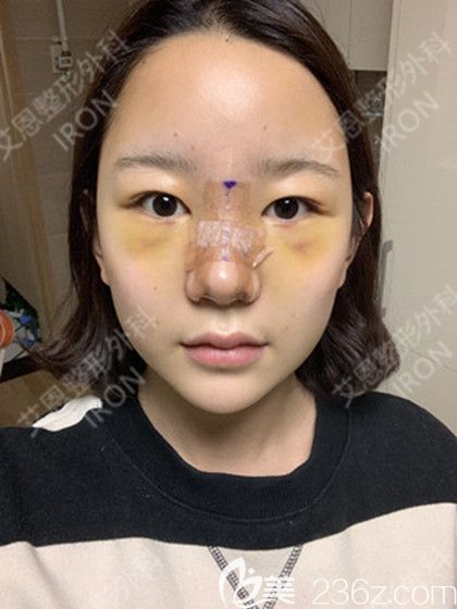 艾恩整形术后第7天 艾恩整形术后第7天