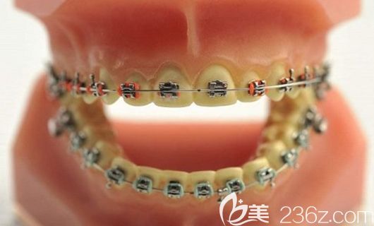 张子扬医生擅长各类牙性畸形的矫治 张子扬医生擅长各类牙性畸形的矫治