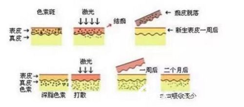 美国赛诺秀755翠绿宝石激光祛斑