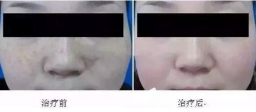 许昌博爱美国赛诺秀激光祛斑实例