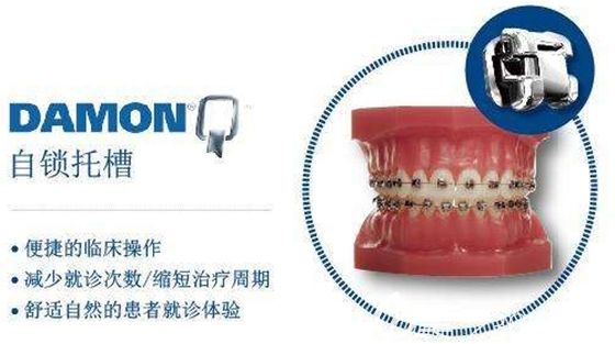 美国Damon自锁牙套优势介绍图 美国Damon自锁牙套优势介绍图