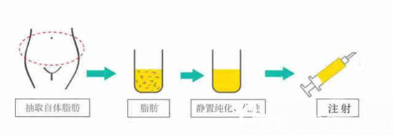 自体脂肪隆胸示意图