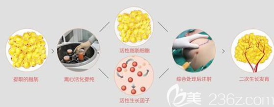 艾恩整形高效脂肪液