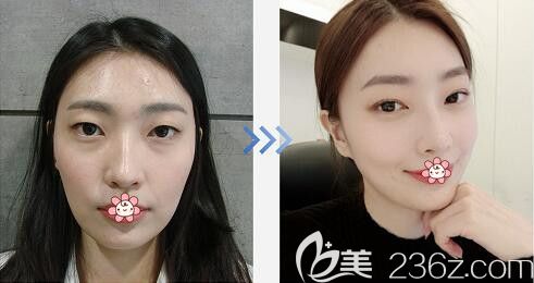 纯真双眼皮案例 纯真双眼皮案例