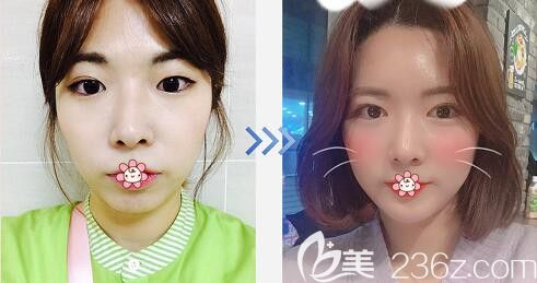 韩国纯真医院做自体脂肪全脸填充效果 韩国纯真医院做自体脂肪全脸填充效果